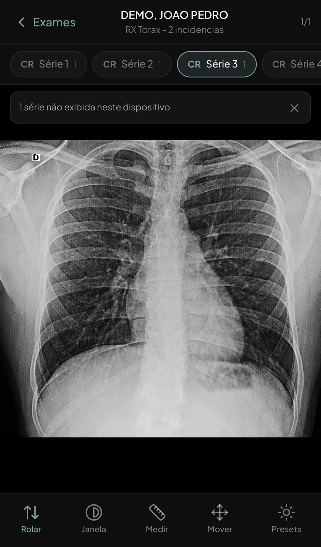 Interface de toque do Lumina Web num celular mostrando uma radiografia de tórax do paciente de demonstração, com as séries no topo e os botões Rolar, Janela, Medir, Mover e Presets embaixo