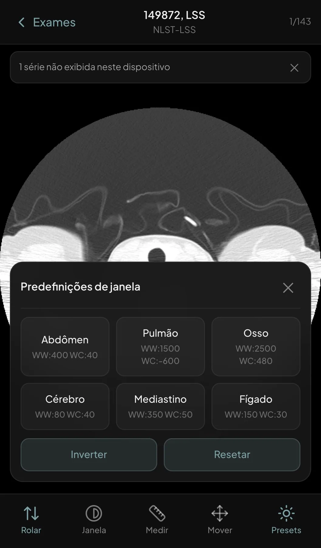Folha de predefinições de janela no celular com Abdômen, Pulmão, Osso, Cérebro, Mediastino e Fígado, cada uma com largura e nível, e os botões Inverter e Resetar
