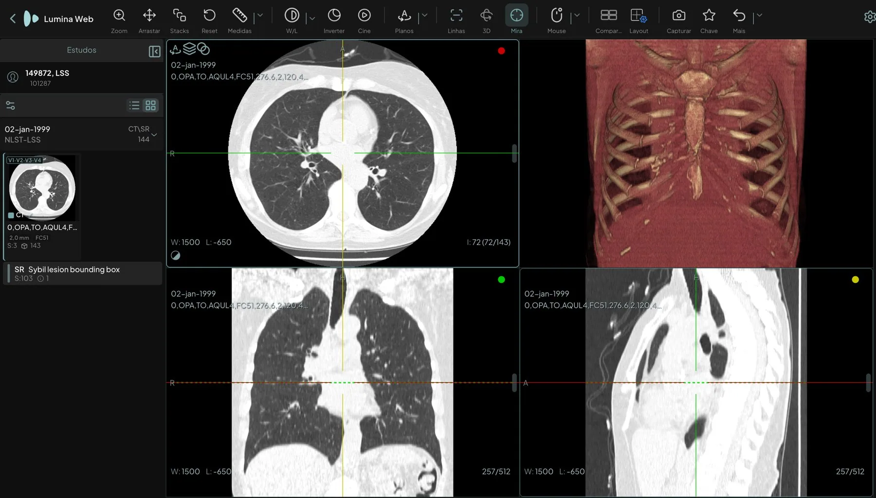 Layout MPR + 3D de uma TC de tórax: axial, coronal e sagital com o localizador ativo nos três planos e o volume renderizado em 3D no quadrante superior direito