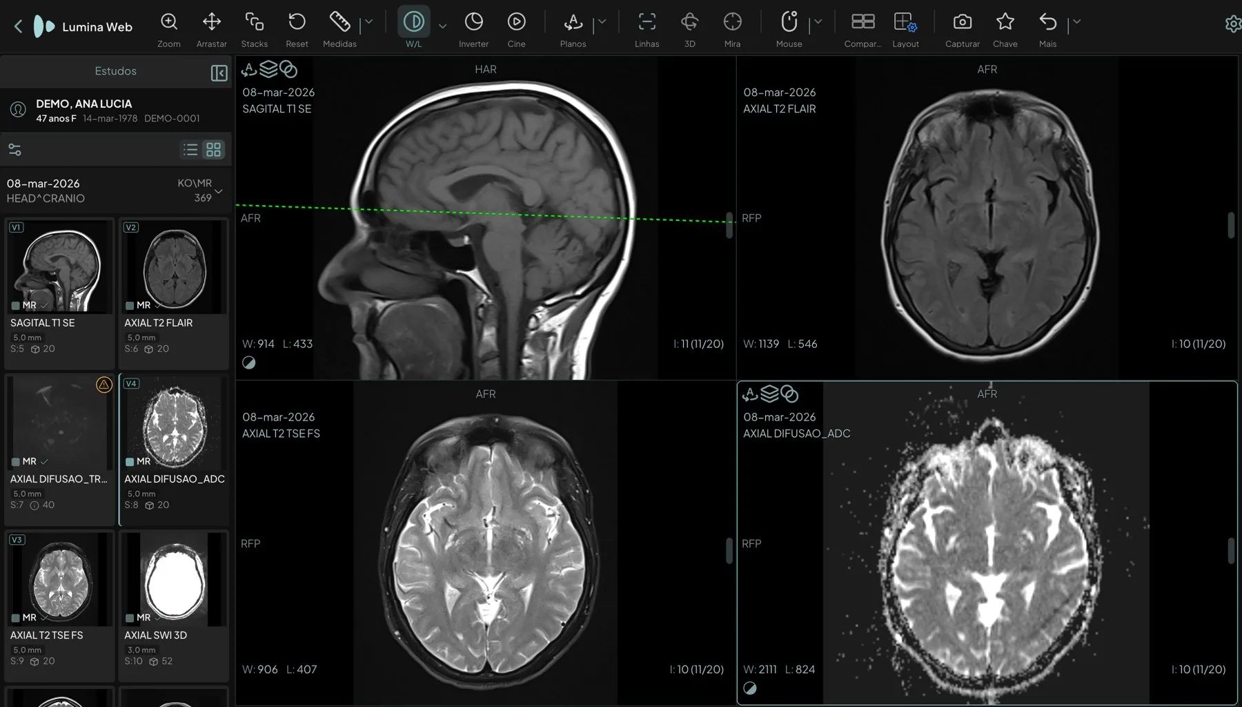 RM de crânio em grade 2×2 montada pelo radiologista: sagital T1, axial T2 FLAIR, axial T2 e mapa ADC, com a linha de referência projetada no sagital