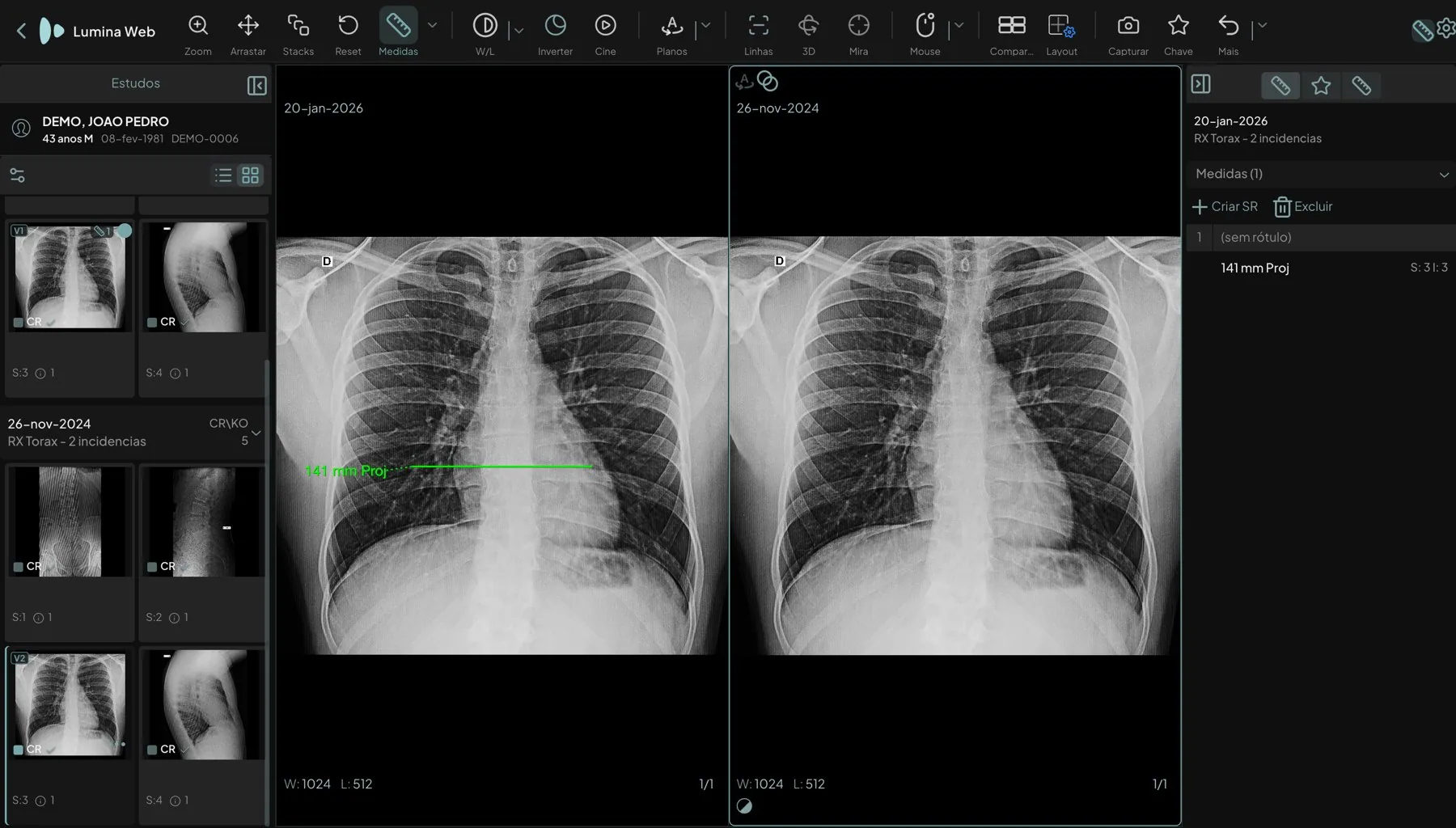 Radiografia de tórax atual de janeiro de 2026 e exame anterior de novembro de 2024 lado a lado, com uma medida de 141 mm na atual e o painel de medidas aberto à direita
