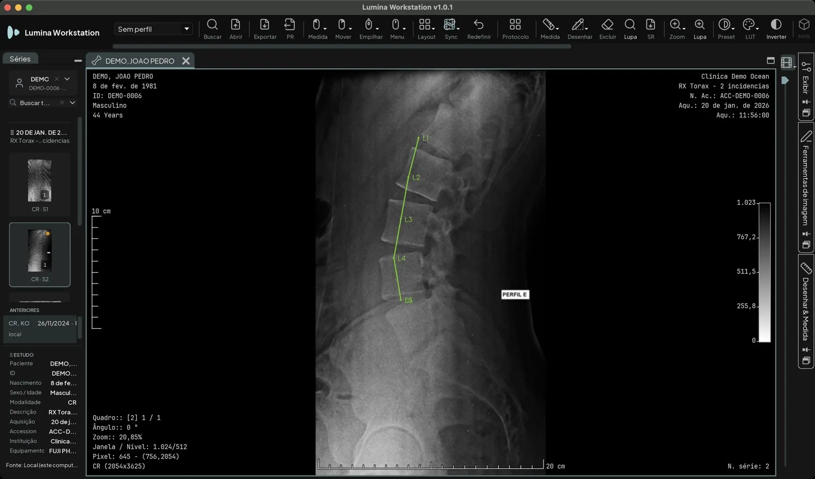 Radiografia lateral da coluna lombar com os rótulos L1 a L5 da marcação de coluna