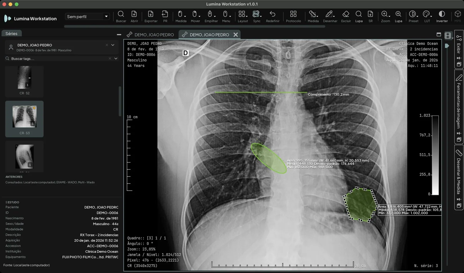 Radiografia de tórax com uma distância de 130,2 mm, uma área elíptica com área, média, desvio-padrão, mínimo e máximo, e um contorno à mão livre com a sua estatística